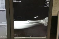 Leg ER x ray.jpg