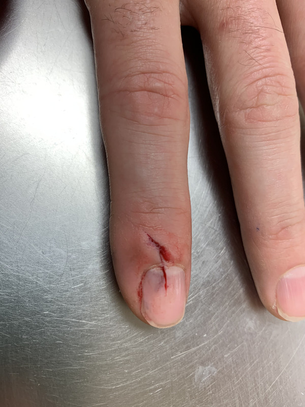 Finger-Squeezer-Injury.jpg